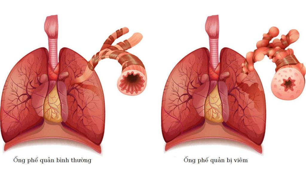 Hen phế quản là bệnh viêm mãn tính đường thở