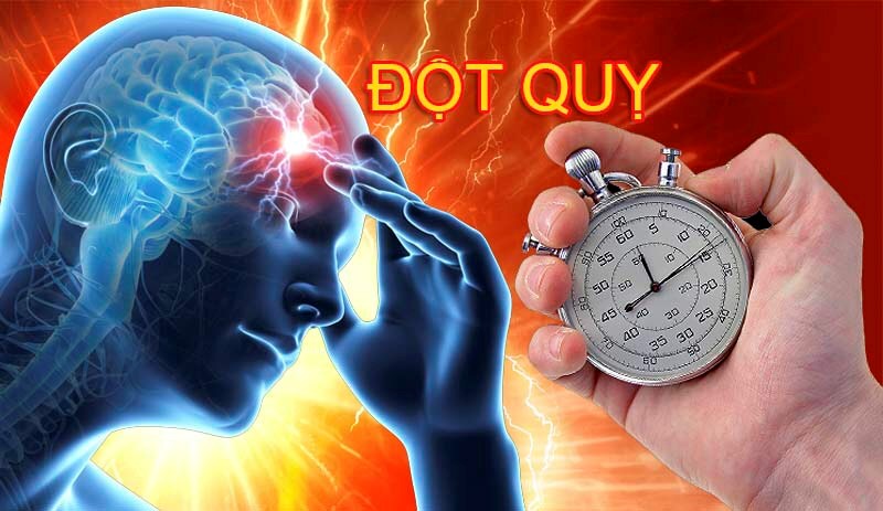Đột quỵ não