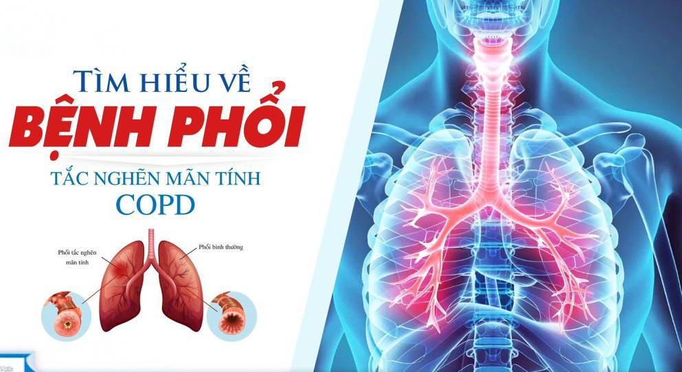 COPD bệnh phổi tắc nghẽn mạn tính
