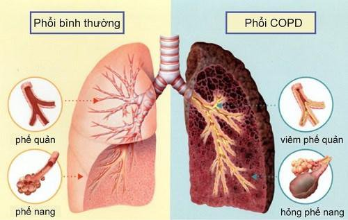 Bệnh phổi tắc nghẽn mạn tính