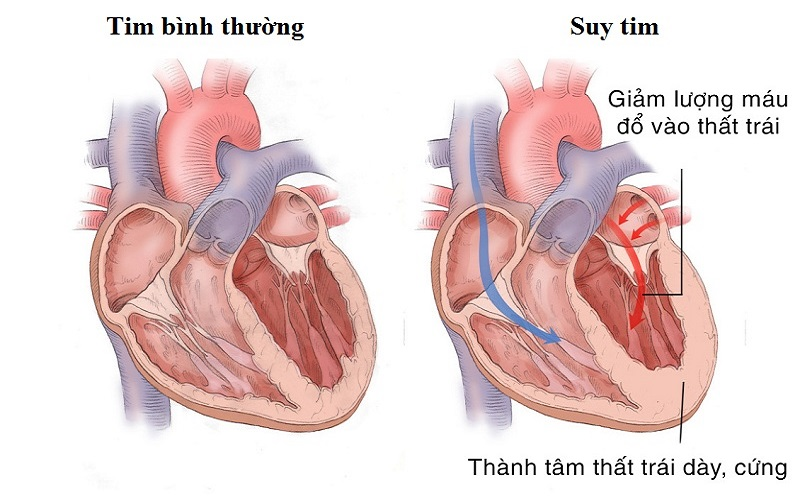 Suy tim mạn tính