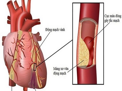 Bệnh mạch vành mạn tính