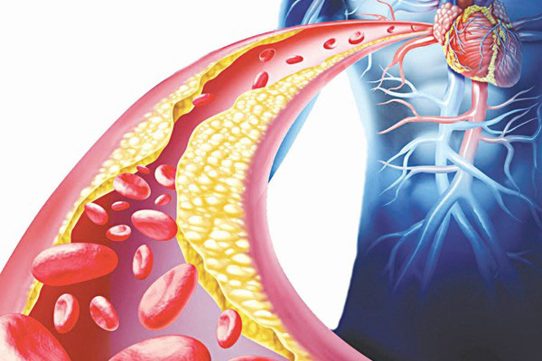 Rối loạn mỡ máu